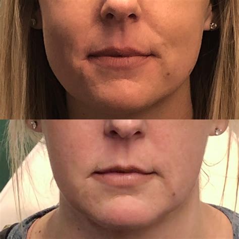 How Botox Can Be Used For Face Slimming Boss Gal Beauty Bar