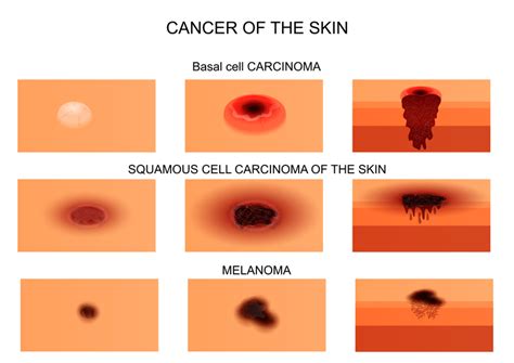 3 Skin Cancer Types And Their Warning Signs University Health News