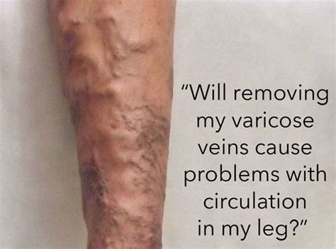 Effect Of Varicose Vein Removal On Circulation Totality