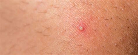 What Is Folliculitis And What Does It Have To Do With Hair Transplants