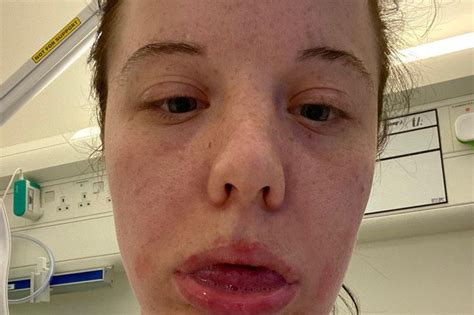 Woman Suffers 14 Anaphylactic Shocks After Having Covid Jab Belfast Live