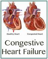 Pictures of Treatment Of Congestive Heart Failure Includes