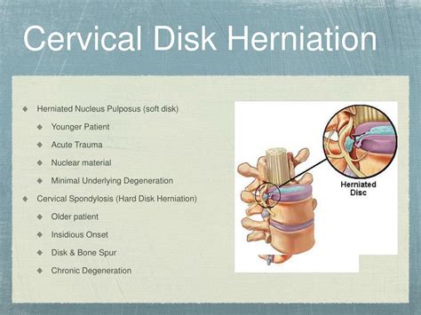 Intradural Cervical Disc Herniation