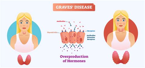 Graves Disease Symptoms Diagnosis And Treatment Healthsoul