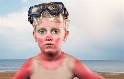 Crayfish Complexion Ragged Skin How To Avoid Or Treat A Sunburn