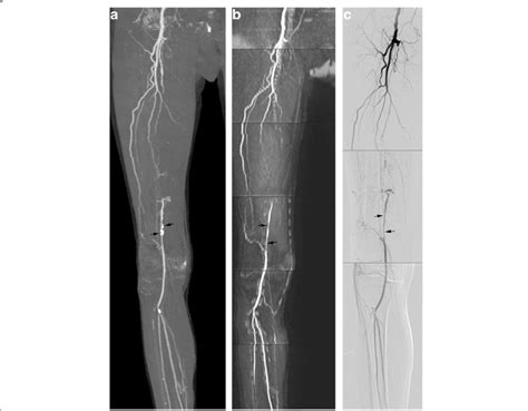 Occlusion Of Right Femoral Artery Was Seen At Cta A And Qiss Mra B