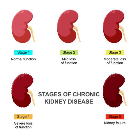 Stages Of Chronic Kidney Disease Infographic Concept Vector