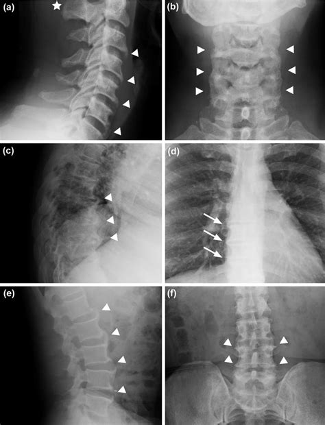Radiographic Imaging Of The Cervical Thoracic And Lumbar Spine Of A