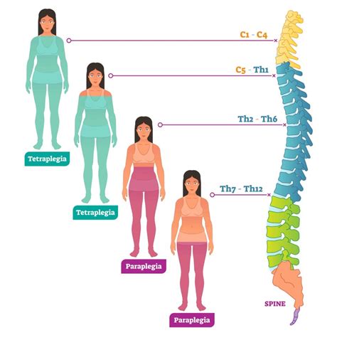 Spinal Cord Injury Level Of Neurological Injury Propel Physiotherapy Propel Physiotherapy