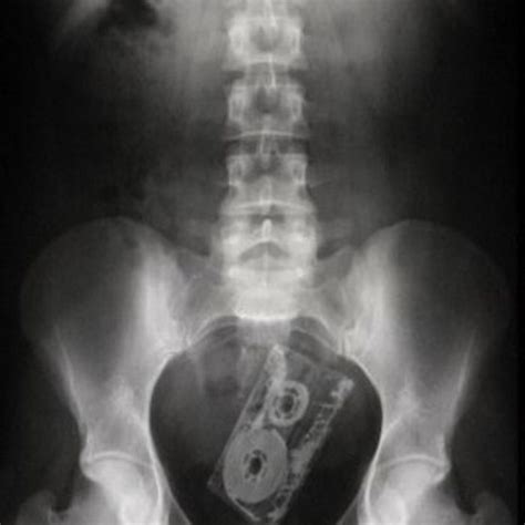x ray anal