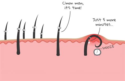 Ingrown Hair Cyst Causes And Its Risk Factors