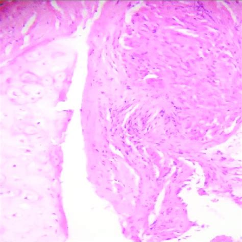 Histopathology Of Pulmonary Sarcoid Granulomas Composed Of Noncaseating