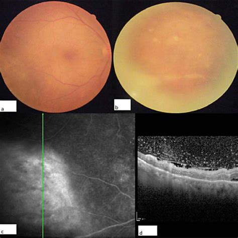 Case 1 Fundus Photographs Of The Right A And Left B Eyes Reveal