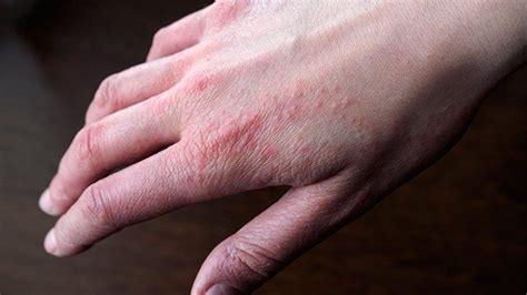 Is Eczema Contagious 2 Skincare Experts Weigh In