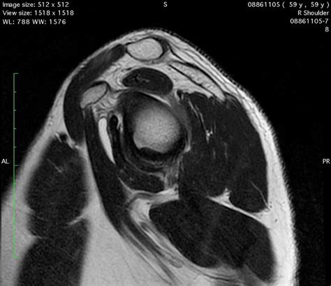 Sagittal Magnetic Resonance Imaging Of The Right Shoulder T2 Weighted
