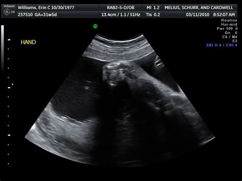 Williams Pregnancy Ultrasound Week 32 Arm