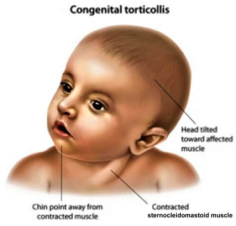 Torticollis In Adults Spasmodic Torticollis Infant Torticollis Causes