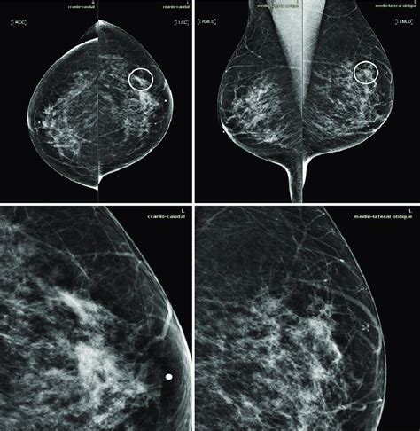 Mammograms In A 51 Year Old Woman With Invasive Ductal Carcinoma The
