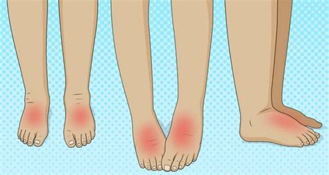 What Are Causes Of Swollen Feet