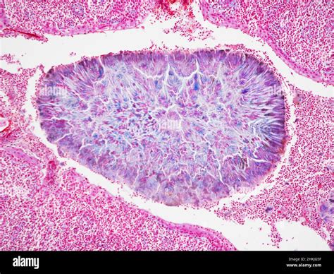 Calcified Mass In Tonsil Light Micrograph Stock Photo Alamy