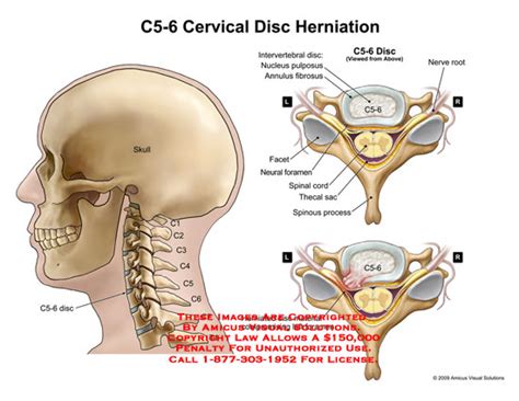 Amicus Illustration Of Amicus Anatomy Cervical Intervertebral Disc Space C Vertebra Annulus