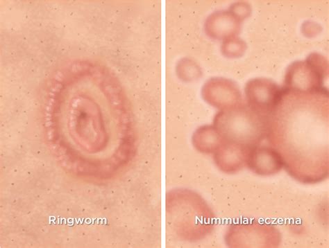 Eczema Nummular Eczema Vs Ringworm Pictures