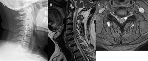 Preoperative Images Of The Cervical Spine A X Rays B Sagittal