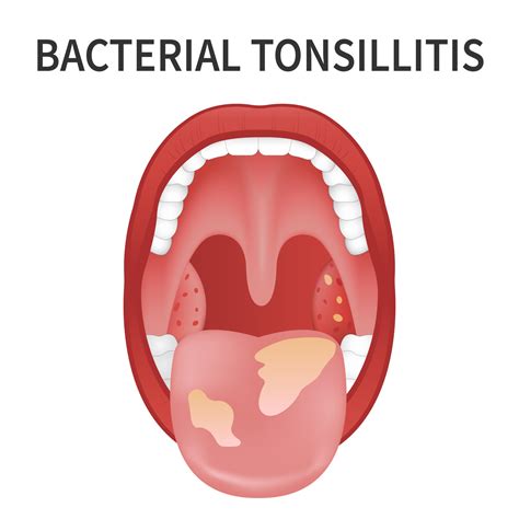 Bacterial And Viral Tonsillitis Angina Pharyngitis And Tonsillitis