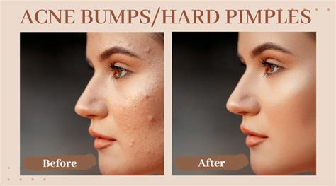 How To Get Rid Of Acne Bumps Or Hard Pimples
