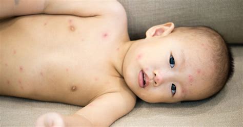Baby Rash On Back And Stomach How To Identify Treat And Prevent
