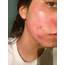 Skin Concern Am I Having An Allergic Reaction  SkincareAddiction