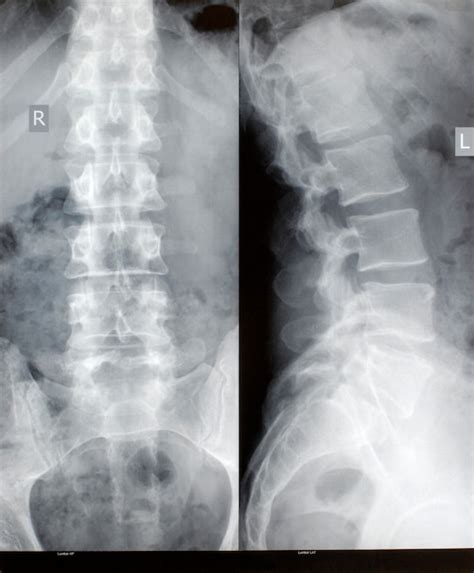 Radiografía De La Espina Dorsal Foto Gratis