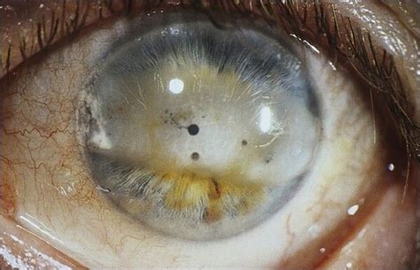 Hd corneal burr for rust ring. 7 best Diamond burr superficial keratectomy after ...