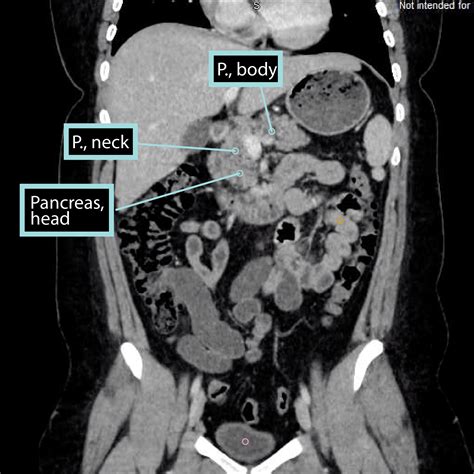 Gross Anatomy Glossary Pancreas Imaging Draw It To Know It