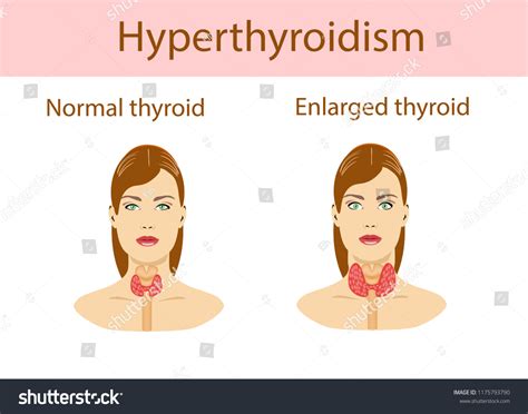 Woman Enlarged Hyperthyroid Gland Vector Illustration เวกเตอร์สต็อก