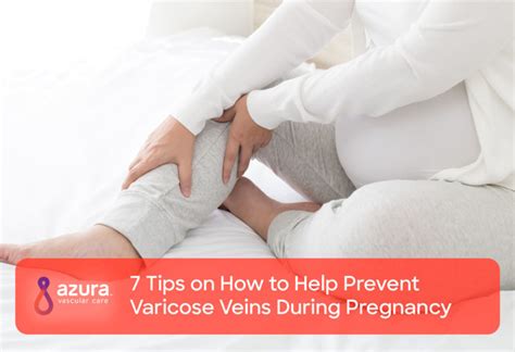 How To Help Prevent Varicose Veins During Pregnancy