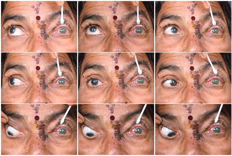 Orbital Apex Syndrome As A Complication Of Herpes Zoster Ophthalmicus