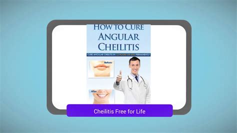 Angular Cheilitis Treatment Youtube