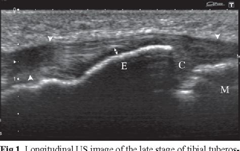 Osgood Schlatter Disease In Ultrasound Diagnostics A Pictorial Essay