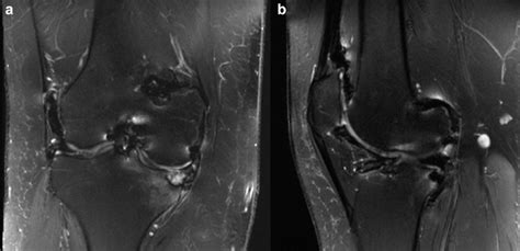 Coronal A And Sagittal B Fat Suppressed T2 Weighted Magnetic