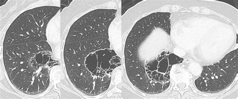 Chest Computed Tomographic Images Show Bullous Emphysema In The Right