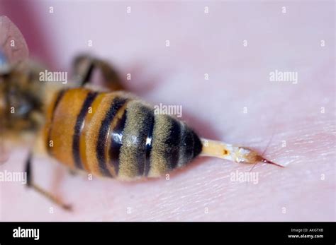 Bee Sting Skin Hi Res Stock Photography And Images Alamy