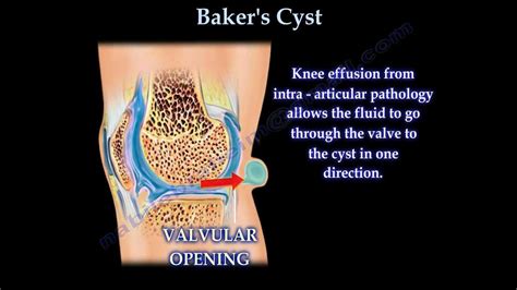Baker S Cyst Everything You Need To Know Dr Nabil Ebraheim YouTube