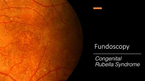 Congenital Rubella Syndrome Retinopathy Fundoscopy Youtube