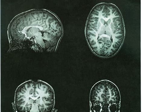 Can An Mri Detect Dementia Readementia