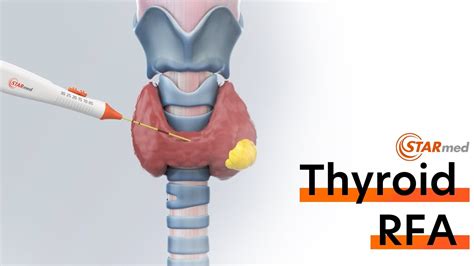 Thyroid Radiofrequency Ablationrfa Procedure Youtube