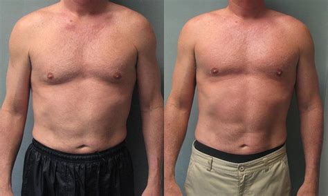 File55 Year Old Male With Moderate Gynecomastia Before And After Gynecomastia Surgery