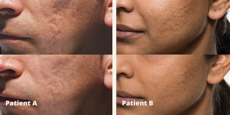 Before And After Acne Scars Reduction Indianapolis Carmel Fishers