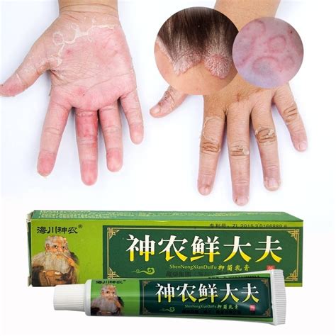 natural chinese medicine antibacterial cream psoriasis eczema