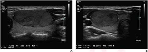 Pediatric Thyroid Nodules On Ultrasound Deep Learning Model And Ti